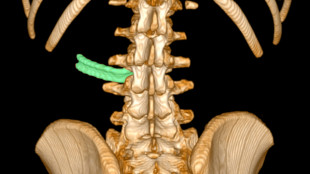 Leva del freno nella schiena per 3 anni, scoperta da radiografia e rimossa